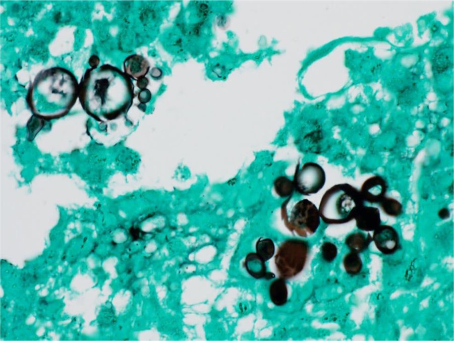 Exame micológico: leveduras com múltiplos brotamentos